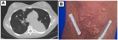 DOCK 8 Deficiency, EBV+ Lymphomatoid Granulomatosis, and Intrafamilial Variation in Presentation